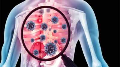 New tool can predict TB death risk at diagnosis, says study | India News